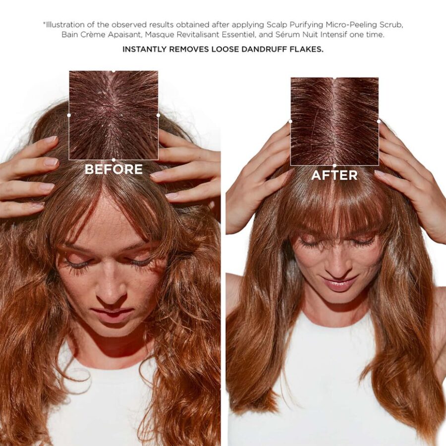 a picture of a model showing dandruff on scalp before and after use of the symbiose hair care line.